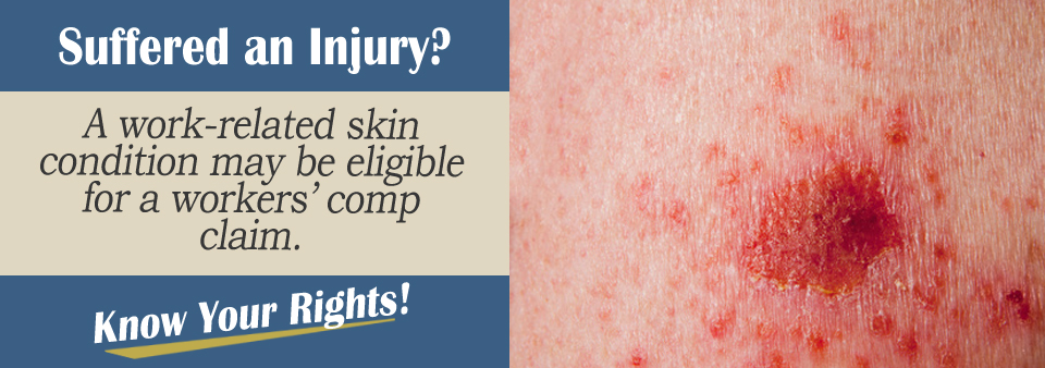 What is a Skin Disorder Injury Worth in a Workers’ Compensation Claim?